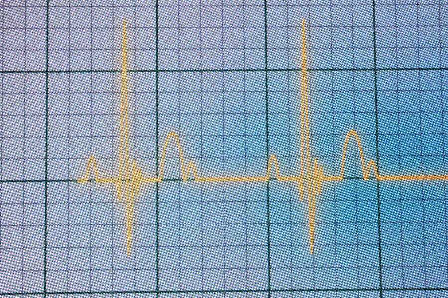 EKG u kliničkoj praksi 6